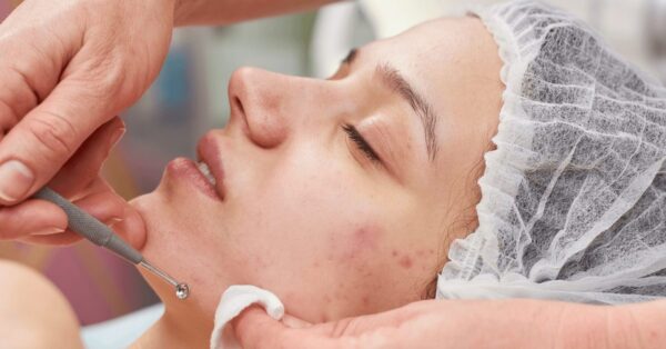 blackheads skin congestion treatments - sensitive skin treatments