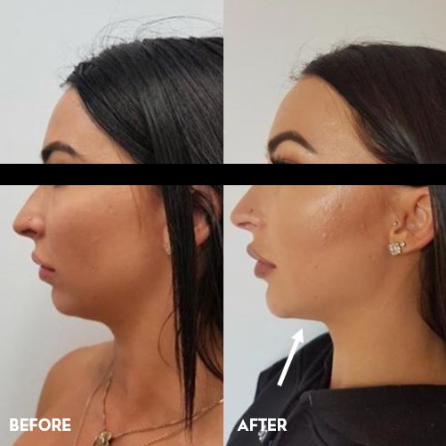 Jawline sculpting before and after: the best treatments for a