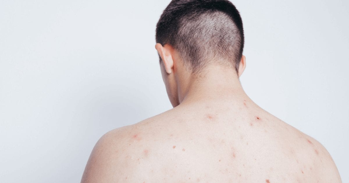 Don't turn your back on back acne - Mayo Clinic Health System