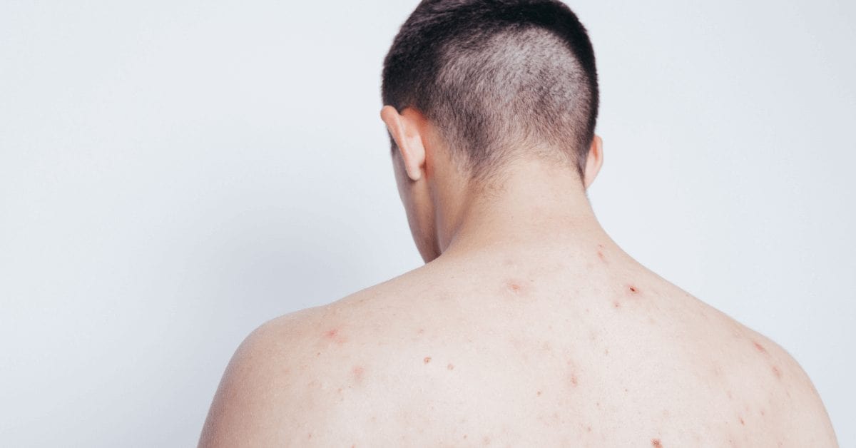 Back Acne Common Causes And How To Treat It Australian Skin Clinics