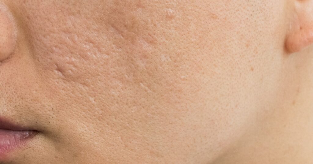 Acne scarring and how to treat it | Australian Skin Clinic