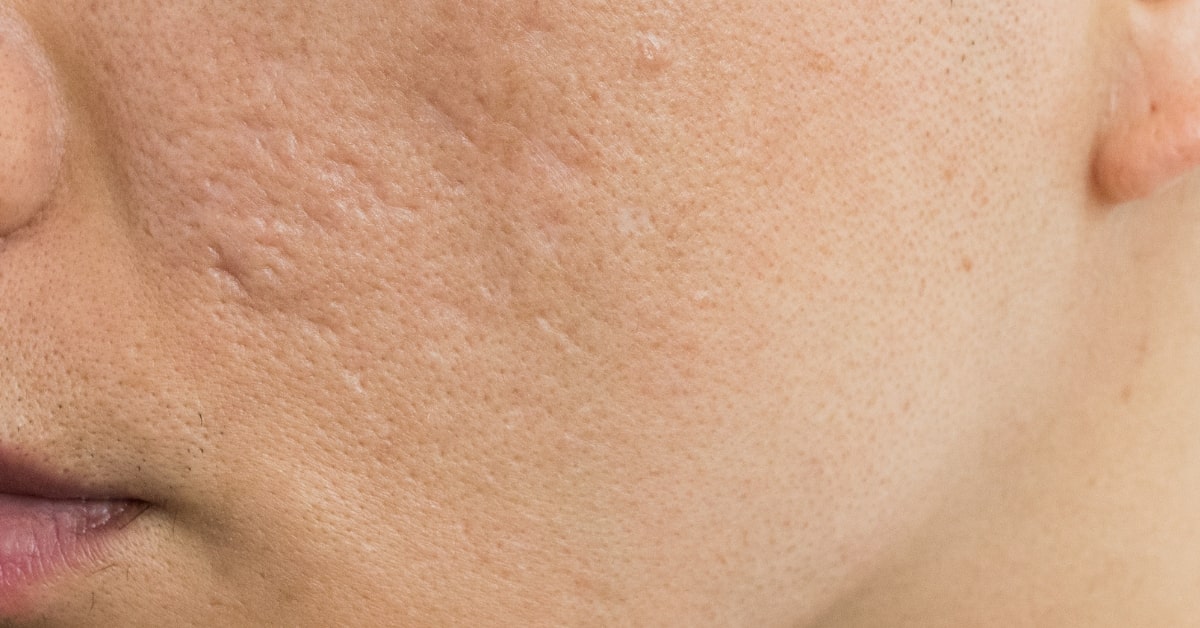 acne scarring male