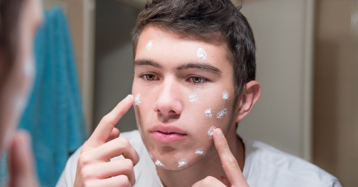 adult acne male