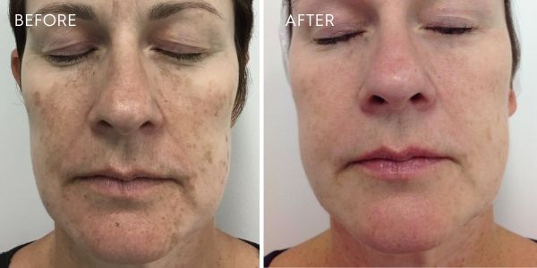 laser for pigmentation face results