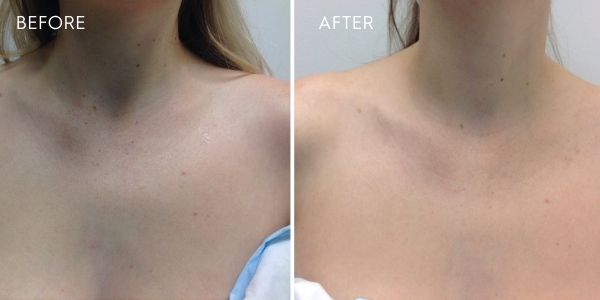 laser for pigmentation chest results