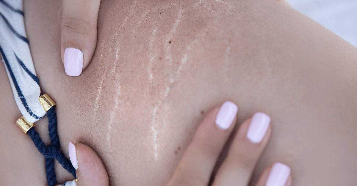 Natural Home Remedies for Stretch Marks - PharmEasy Blog