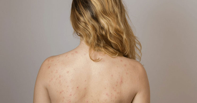 We Ask a Derm: How Do I Clear Up Bacne and Back Acne Scars?