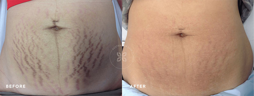 Stretch mark treatment - Before and After 