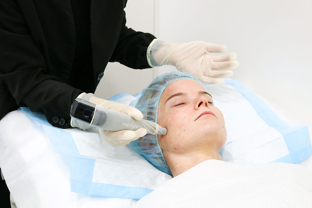 Microneedling Skin treatment