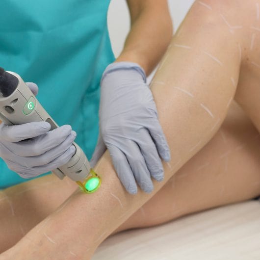 Professional Laser Hair Removal