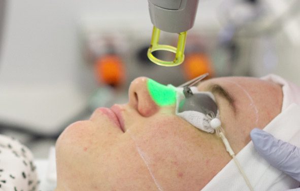Laser for redness skin treatment