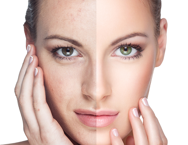 Common Concerns Skin Treatment - Before and After Result