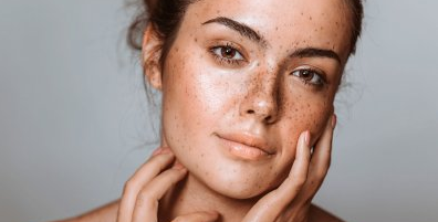 Skin Treatment for Pigmentation