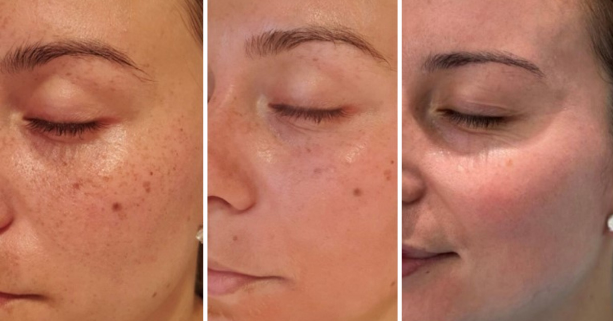 Cosmelan Peel Treatment