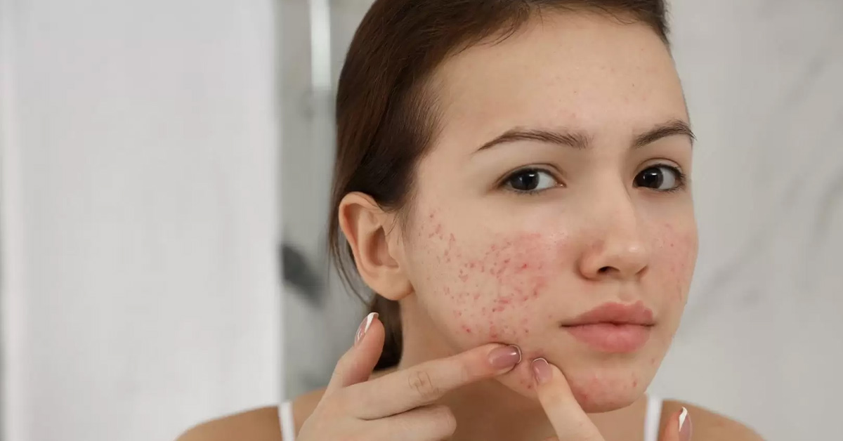 Acne - Australian Skin Clinics