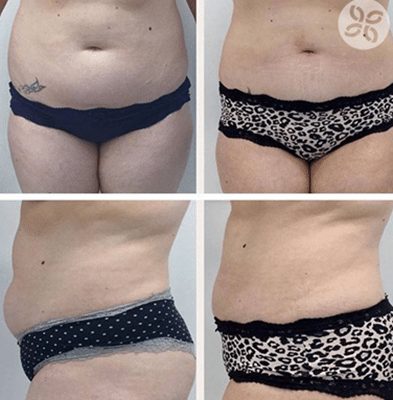 Abdomen Cryo Fat Freezing before and after images -2