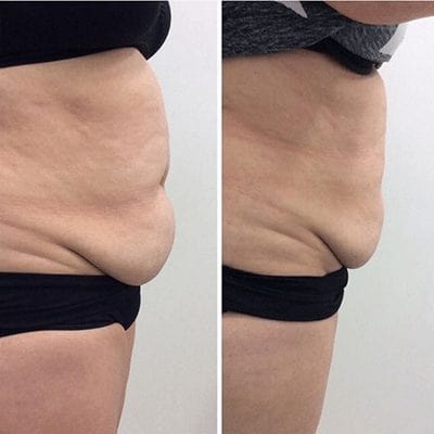 Abdomen Cryo Fat Freezing before and after images - 3