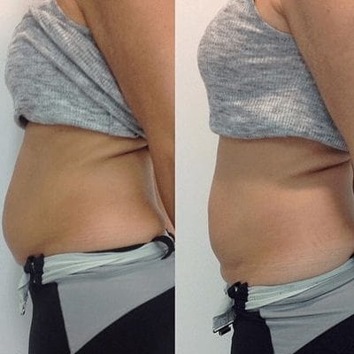 Abdomen Cryo Fat Freezing before and after images