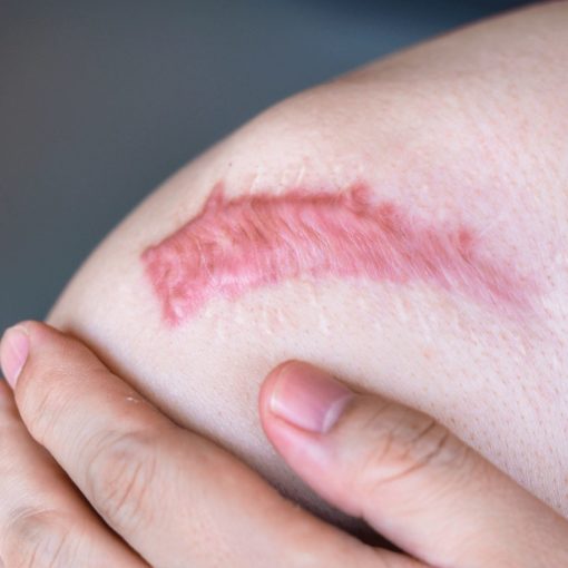 Keloid Scar - Skin scarring Treatments - Australian Skin Clinics
