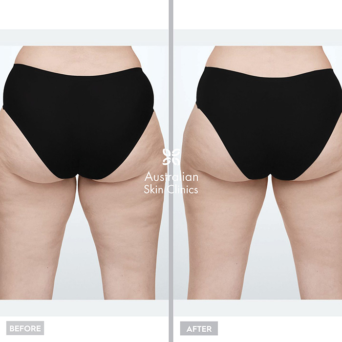 Fat Freezing - CoolSculpting® Before and After images