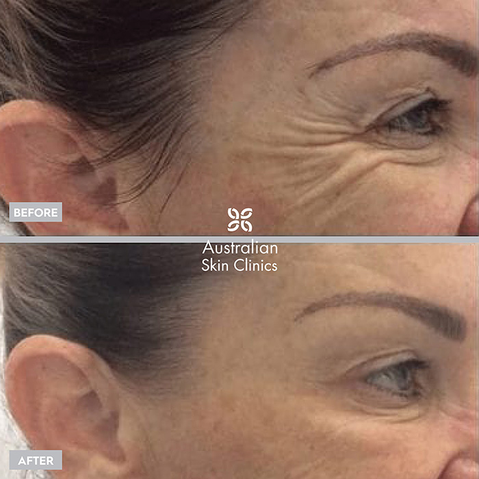 Anti-wrinkle skin injection results before and after