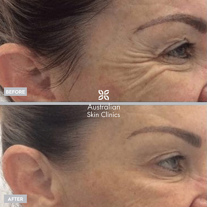 Anti-wrinkle Injections - Australian Skin Clinics