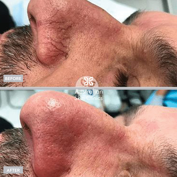 Laser for veins skin treatment before and after images