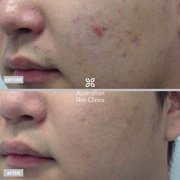 Fractional RF Needling before and after images
