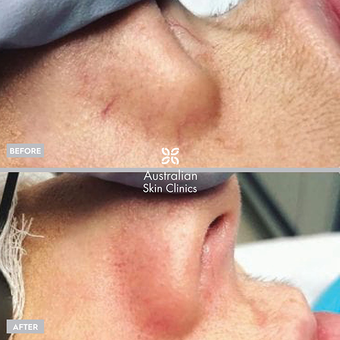 Laser for veins skin treatment before and after images - 2