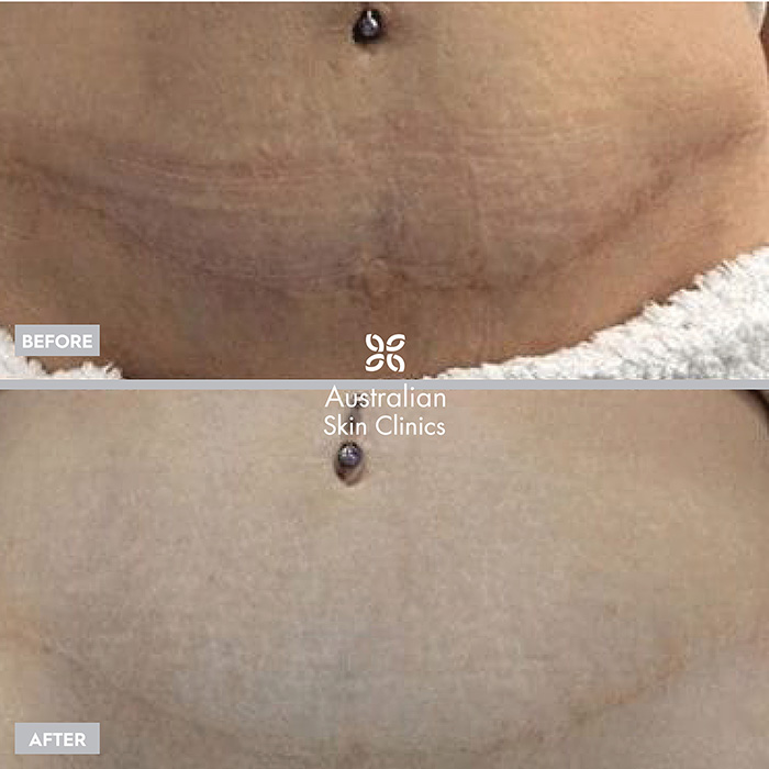 Fractional RF Needling before and after images - 2
