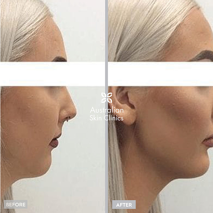 Temple dermal filler before and after images sydney clinic