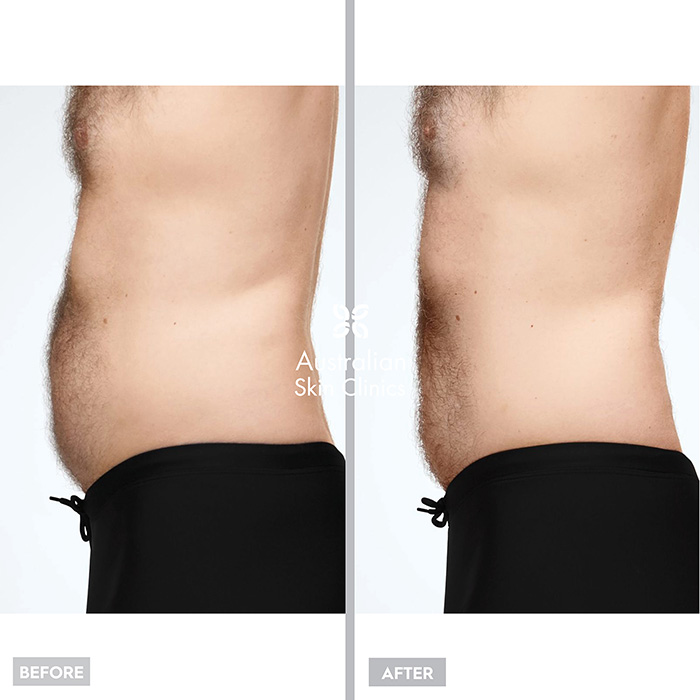 Fat Freezing - CoolSculpting® Before and After images - 2