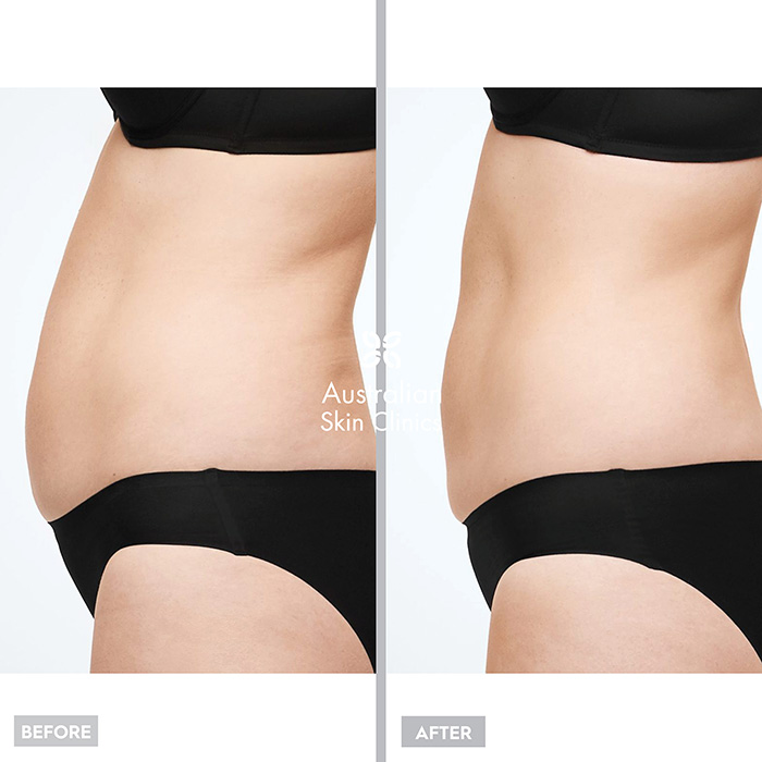 Fat Freezing - CoolSculpting® Before and After images - 3