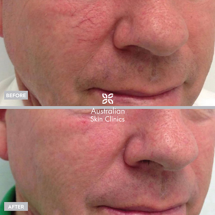 Laser for veins skin treatment before and after images - 3