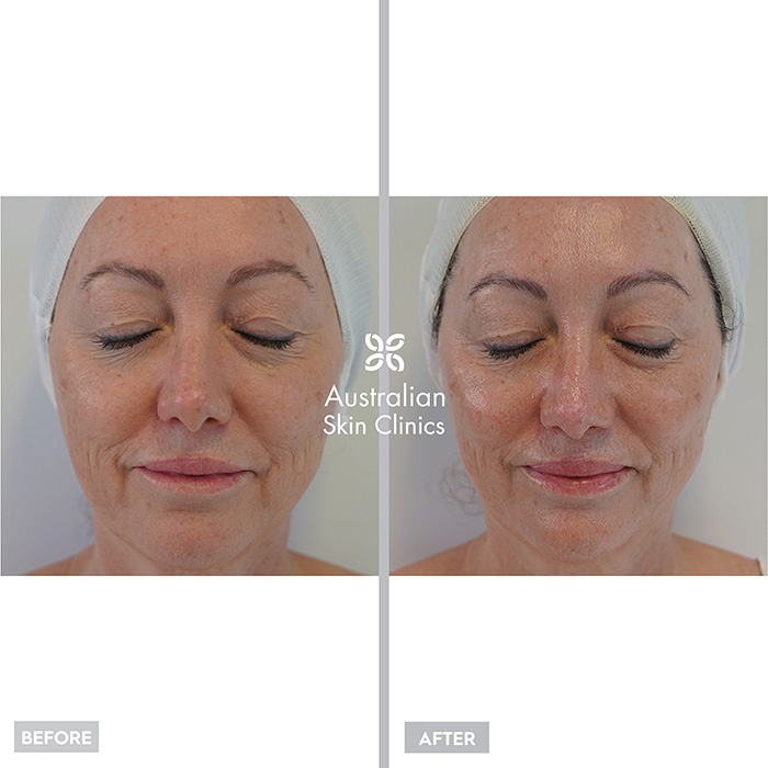 Before and After MediFacials Skin Treatment - Australian Skin Clinics
