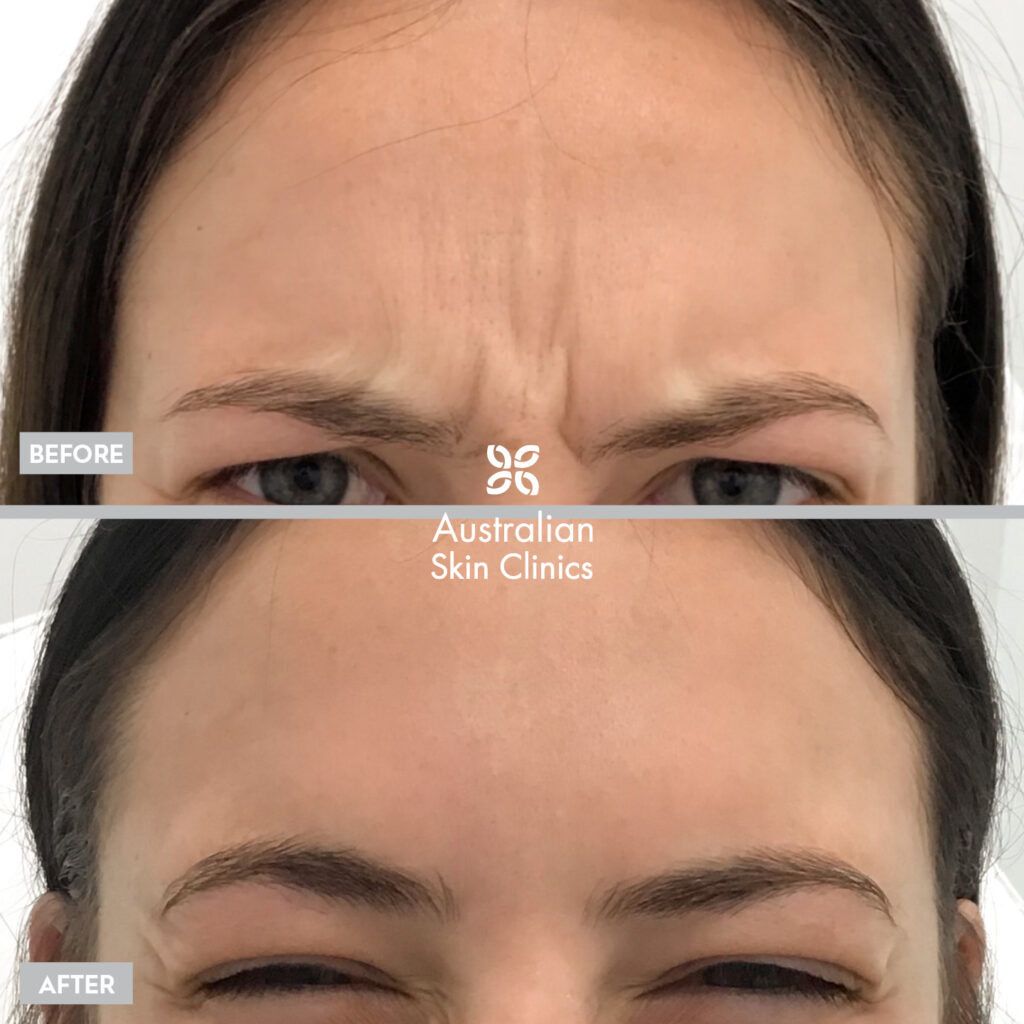 Anti-wrinkle skin care results before and after