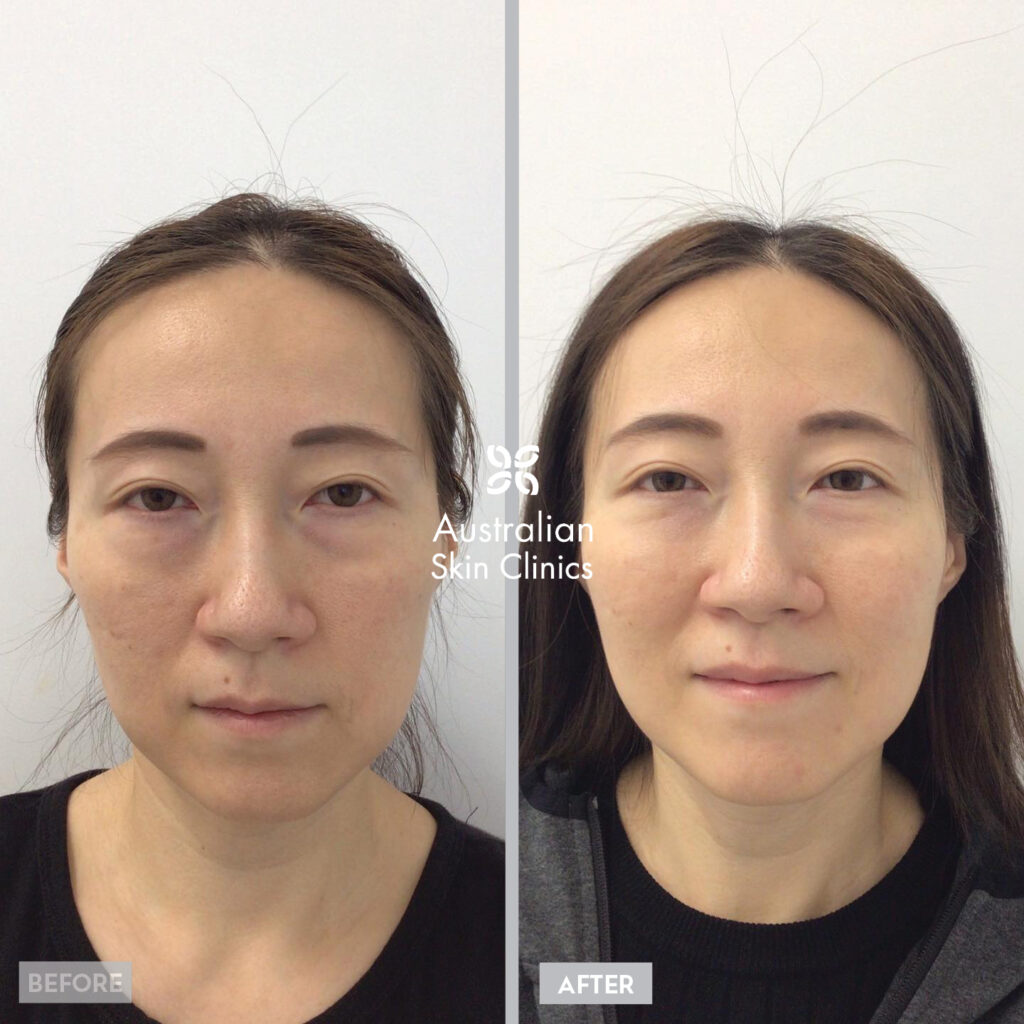 Dermal Filler Injections before and after images Brisbane