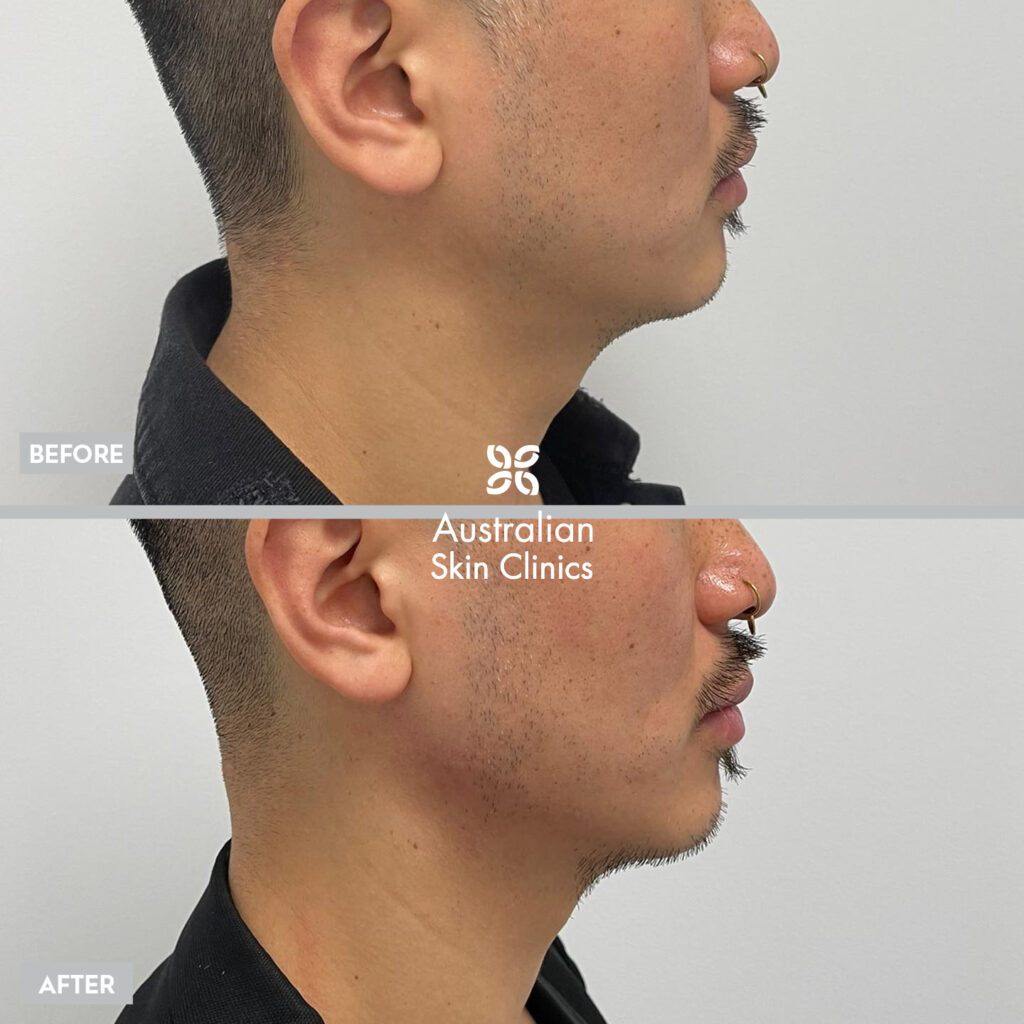 Dermal Filler Knox before and after images