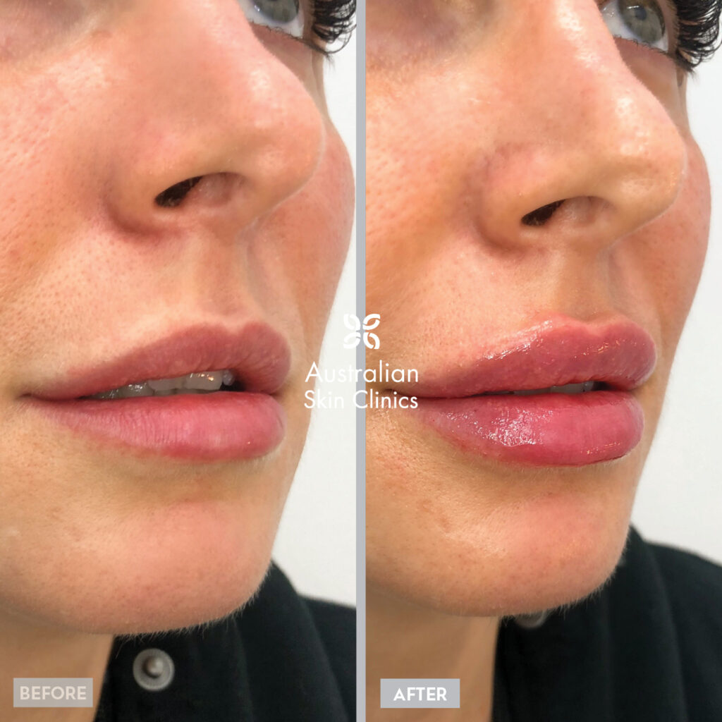 Lip Filler Injections Australian Skin Clinics 4902