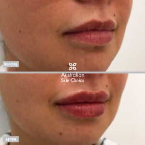 Lip Filler Injections Australian Skin Clinics