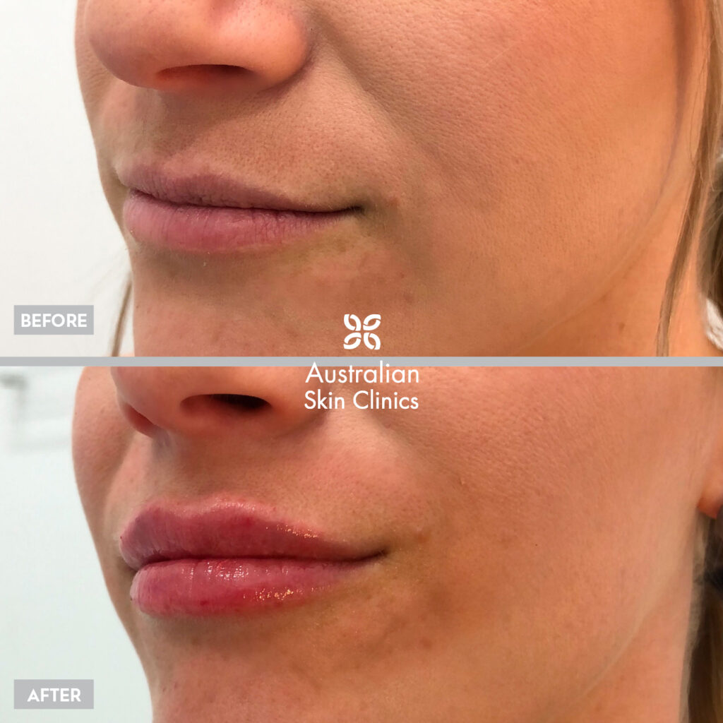Lip Filler - Dermal Filler Injections Results before and after images - 2