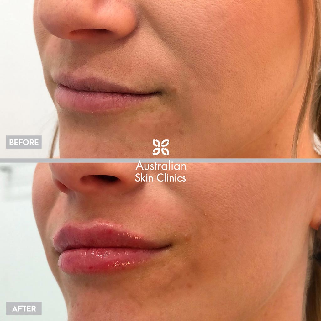Lip Filler - Dermal Filler Injections Results before and after images - 3