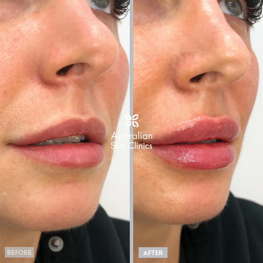 Before and After Lip Filler Injections