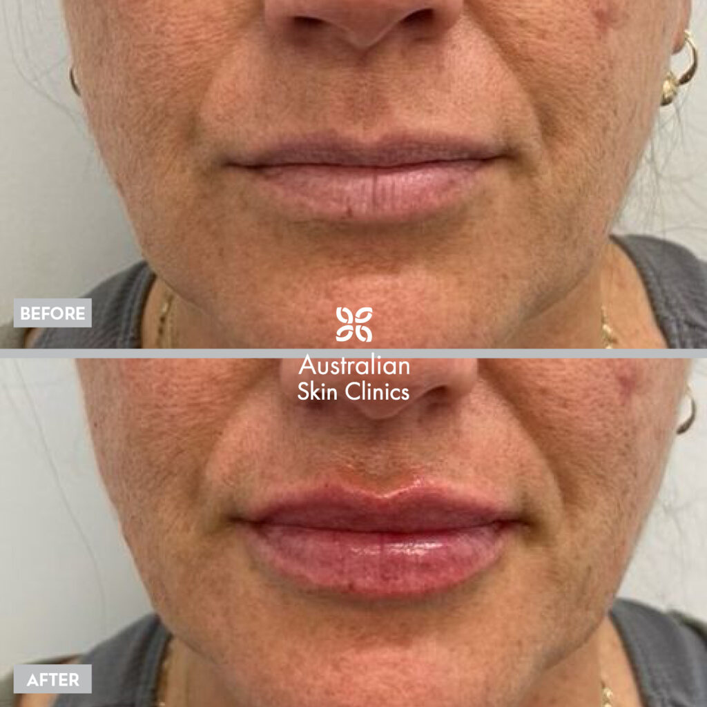 Lip Filler - Dermal Filler Injections before and after images