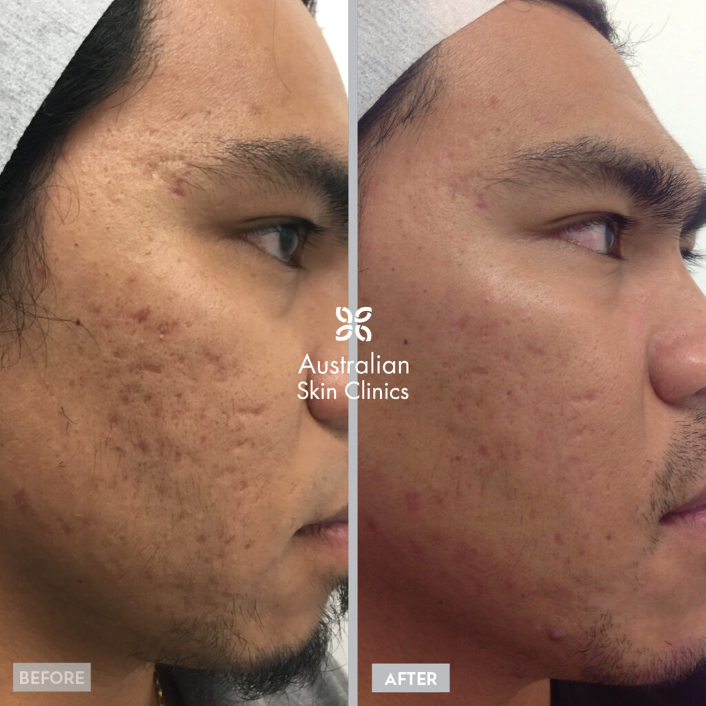 Before + After Lumixa Treatment - Australian Skin Clinics