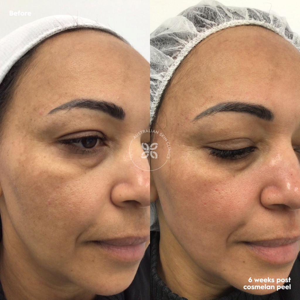 Cosmelan Before and After - reduce pigmentation by up to 95%
