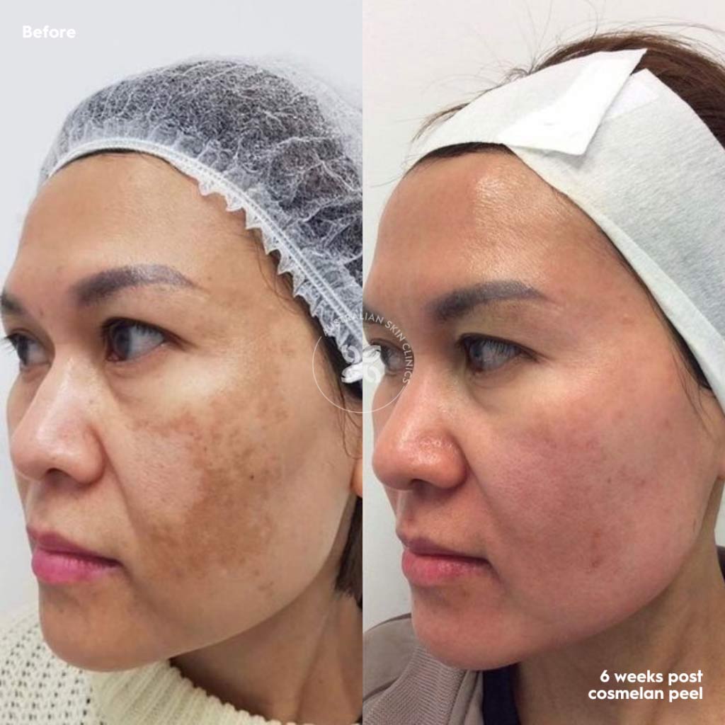 Cosmelan Before and After - reduce pigmentation