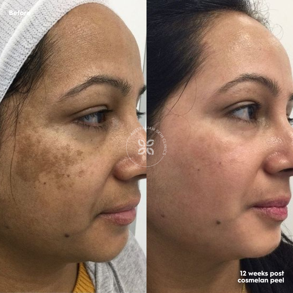 Cosmelan Before and After - reduce pigmentation by up to 95% - 2