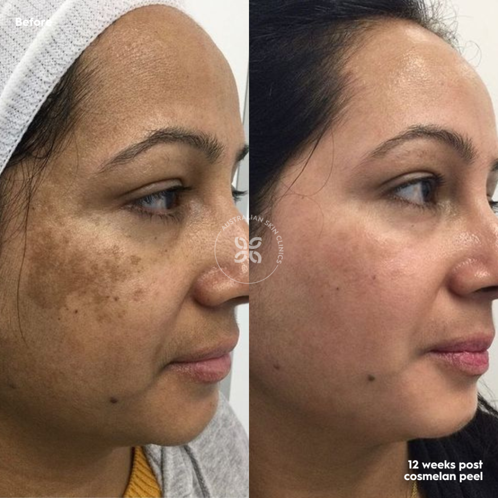 Considering a pigmentation peel? Cosmelan is the real deal! - Injectables