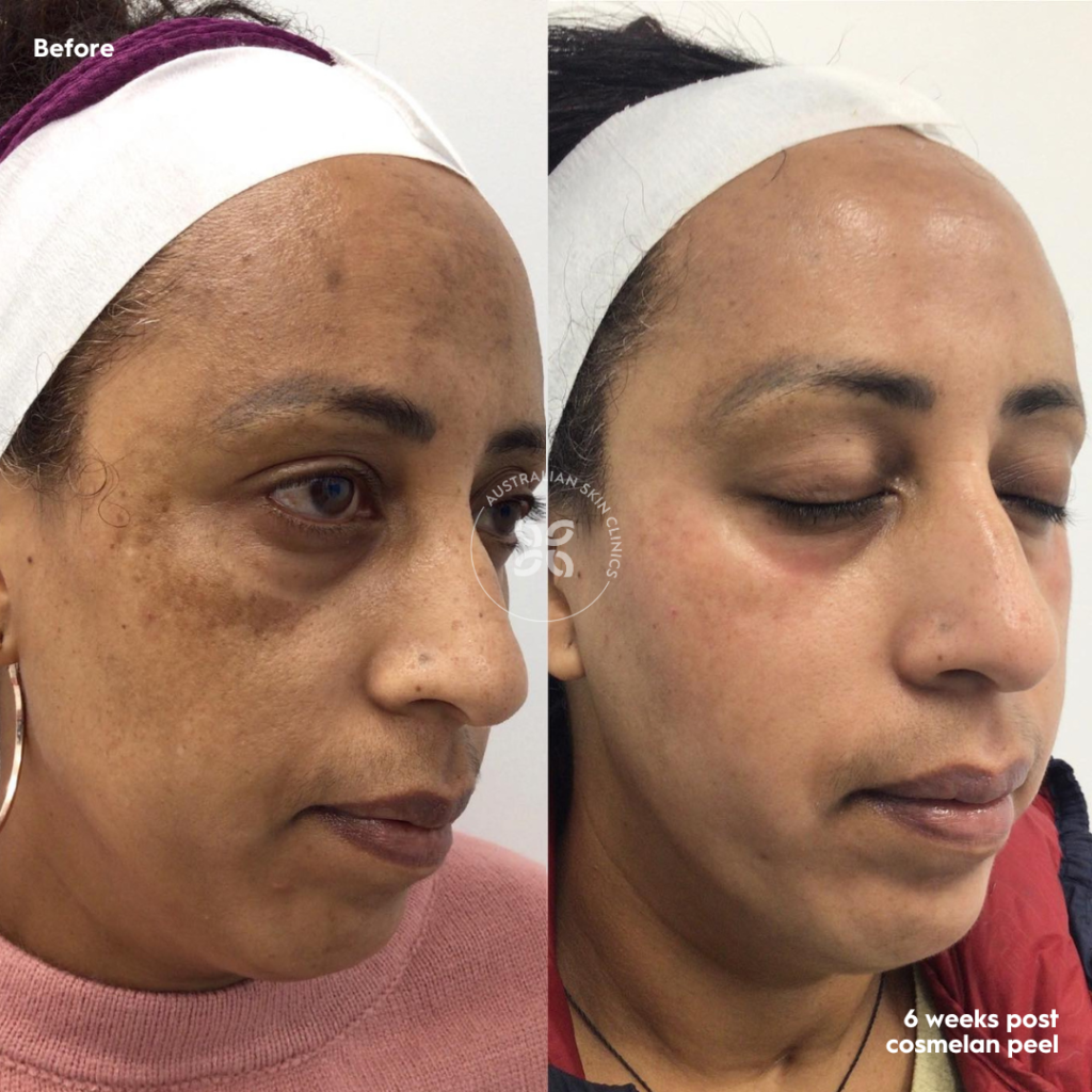 Cosmelan Before and After - reduce pigmentation by up to 95% - 4